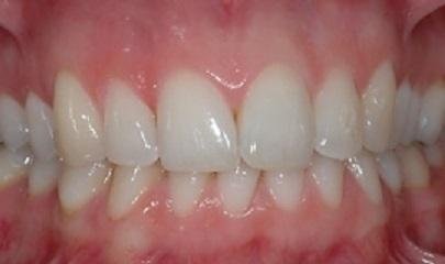 gengive infiammate rimedi dentista salerno