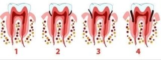 piorrea sintomi trattamenti paradontologia studio dentistico melucci salerno